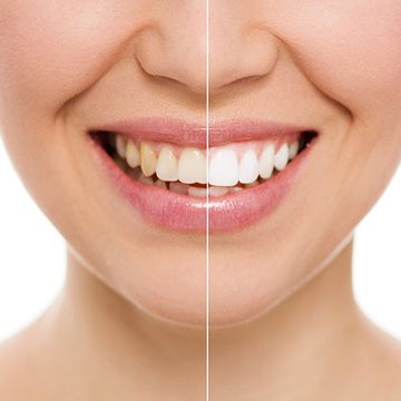 Biodent Clínica Dental Blanqueamiento Dental